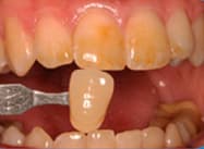 Cypress Springs Family Dentistry - teeth whitening before