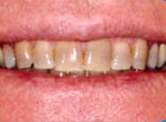 Cypress Springs Family Dentistry - teeth whitening before