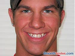Cypress Springs Family Dentistry - six month smiles before