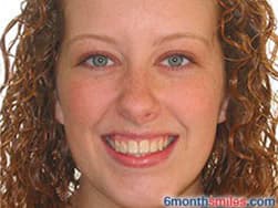 Cypress Springs Family Dentistry - six month smiles after