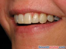 Cypress Springs Family Dentistry - six month smiles after