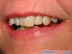 Cypress Springs Family Dentistry - six month smiles before