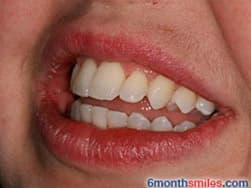 Cypress Springs Family Dentistry - six month smiles after
