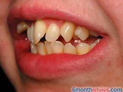 Cypress Springs Family Dentistry - six month smiles before