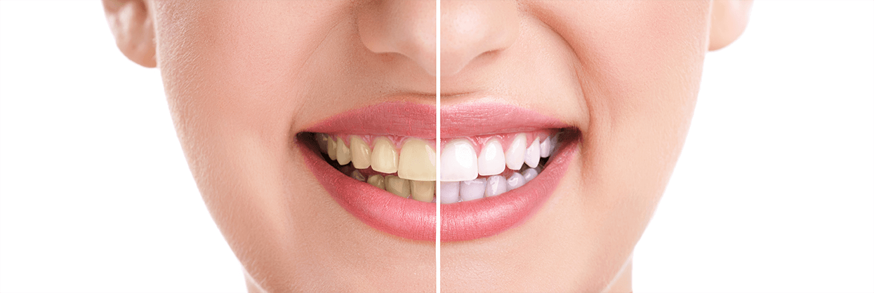 Teeth Whitening in Cypress, Texas